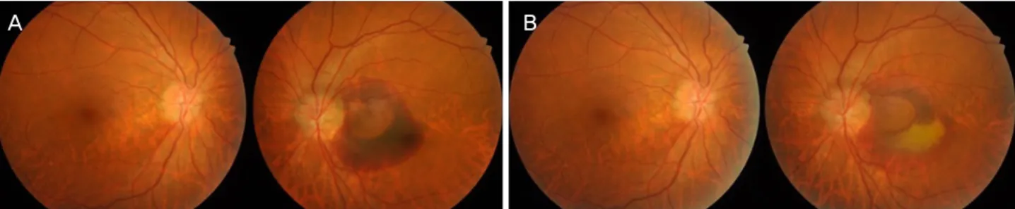 Figure 1. Visual field tests of both eyes at the first visit. 