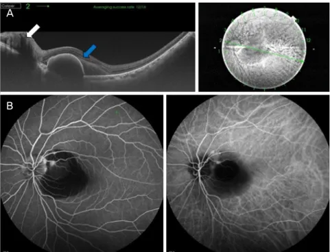 Figure 3. Optical coherence tomography  (OCT) and retinal angiograms of the left  eye