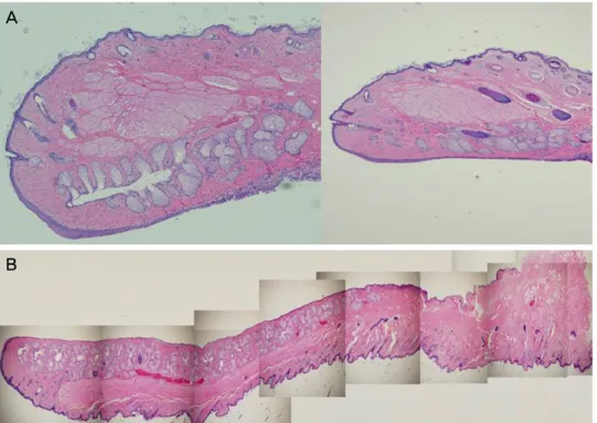 Figure 5. Structures of meibomian glands in different section. In sagittal section (A), although there is an advantage of observing the  entire meibomian gland, there is a disadvantage in that it cannot confirm the structure of the gland structure because 
