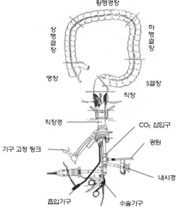 그림  1. 경항문 내시경 미세수술법 (Transanal Endoscopic Microsurgery, TEM) (http://blog.naver.com/dohjt?Redirect=Log&amp;logNo=20056643308) Fig