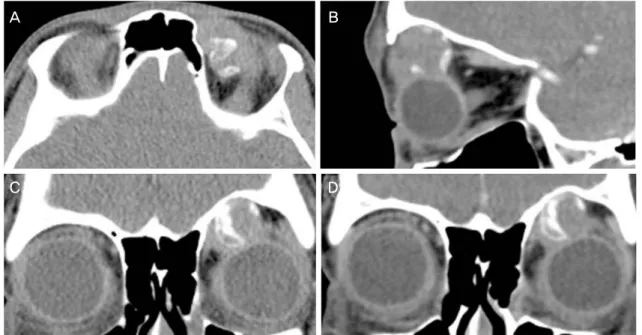 Figure 2. The patient's computed tomography images. Orbital computed tomography images taken preoperatively demonstrate an  orbital mass at the superonasal orbit of the left eye which has a bony component (A, B)