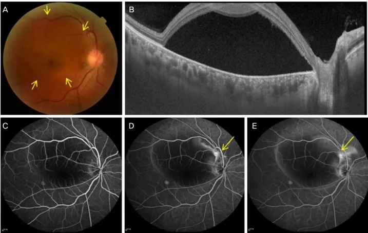 Figure 1. Baseline examination findings at the initial presentation. (A) Fundus photograph and (B) optical coherence tomography show  a serous retinal detachment between upper and lower vessel arcades in the right eye (arrows)
