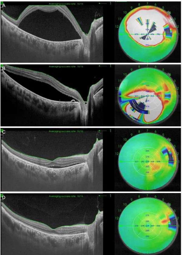 Figure 2. Follow up of the optical coherence tomography (OCT). (A) A large amount of subretinal fluid was visible in the OCT at  the first visit