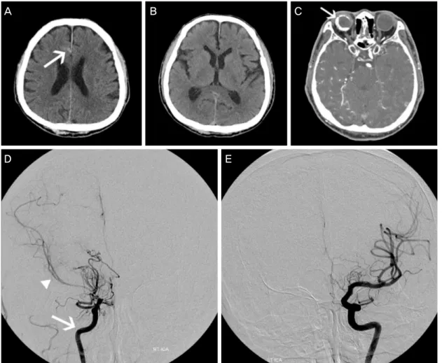 Figure 1. Brain computed tomography (CT) (A-C), and transfemoral cerebral angiography (TFCA) (D, E)