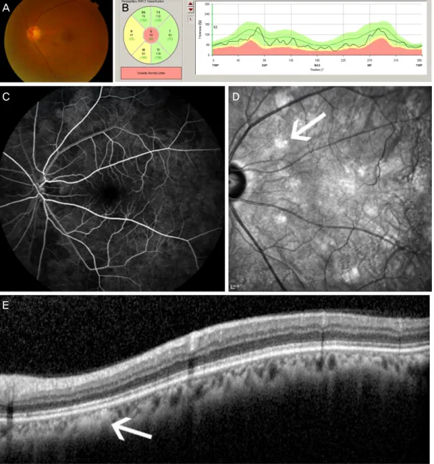 Figure 2. Color fundus photo, peripapillary circular optical coherent tomography (OCT) scan, fluorescein angiography, infrared  fundus image, and retinal OCT scan of the left eye