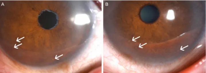 Figure 3. Anterior segment photography of the right (A) and the left eye (B). The white arrows indicate Lisch nodules.