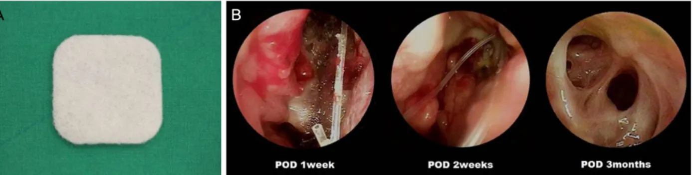 Figure 1. Calcium alginate (Algi-pack Ⓡ ). (A) Photograph of Algi-pack Ⓡ  before insertion into the nasal cavity
