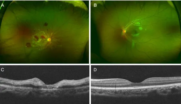 Figure 1. Wide field fundus photography (WFP) and optical coherence tomography (OCT) image on initial presentation