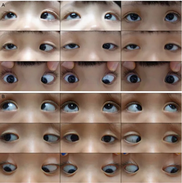 Figure 2. Fields of gaze of extraocular movement. (A) Initial examination shows limitation of movement in all directions in the right  eye