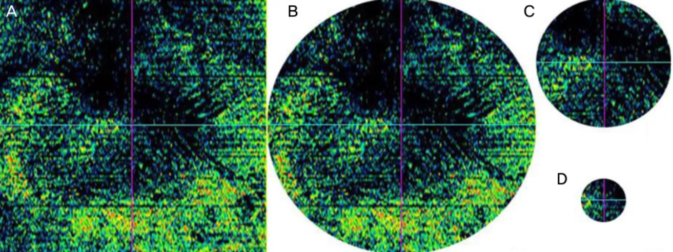 Figure 1. Four types of En Face optical coherence tomography (OCT) images. 6,000 × 6,000 μm square (A), 6,000 μm diameter  circle (B), 3,000 μm diameter circle (C), and 1,000 μm diameter circle (D)