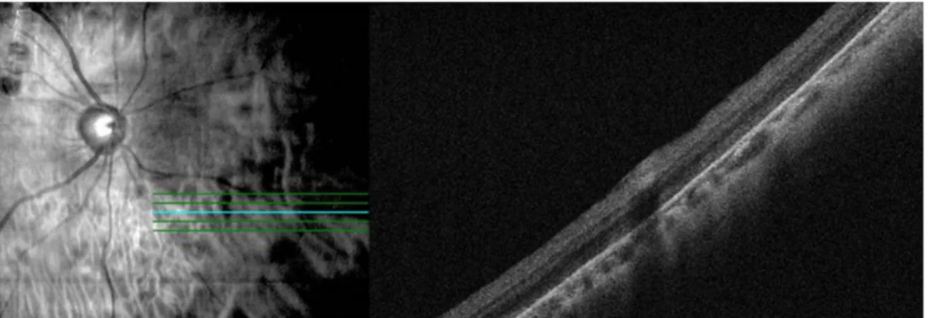 Figure 2. Optical coherence tomography findings of case 1 at 3 months after vitrectomy