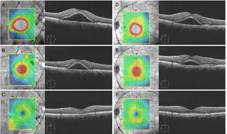 Figure 4. Macular thickness map and optical coherence tomography (OCT) scan of the patients with central serous chorioretinopathy (CSC)