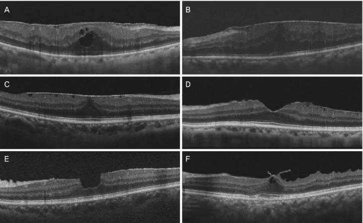 Figure 1. The type of epiretinal membrane in optical coherence tomography images. (A) The cystoid macular edema type shows  globally adherent membrane and formation of intraretinal cystoid space