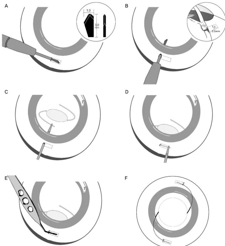 Figure 1. Technique for the intrascleral fixation of intraocular lens (IOL). (A) Scleral tunnel created 1.5 mm from the limbus using  a paracentesis incision diamond knife