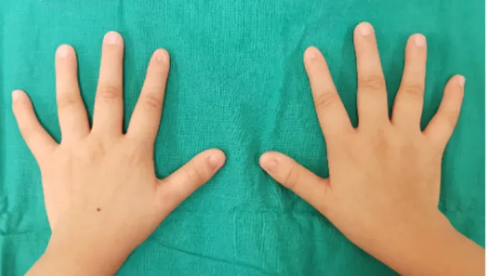 Figure 2. Clinical manifestation of the patient's hands. Dystrophic nails of the thumb and index finger, common findings in the  nail-patella syndrome.drome으로  진단된 1예를 경험하였기에  이를  문헌 고찰과 함께 보고하고자 하는 바이다