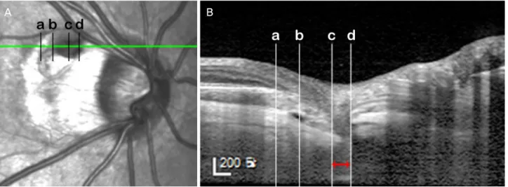 Figure 1. The infrared image (A) and optical coherence tomography (OCT) enhanced depth image (B) describing the location and the measurement of the peripapillary pit of the right eye