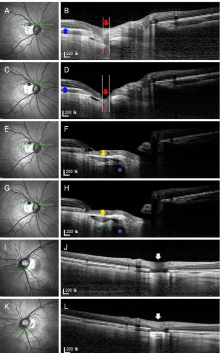 Figure 2. The infrared fundus image (A, C, E, G, I, K), optical coherence tomography (OCT) enhanced depth images (EDI) (B, D,  F, H, J, L) at the first visit (A, B, E, F, I, J) and 2 years after the first visit (C, D, G, H, K, L)