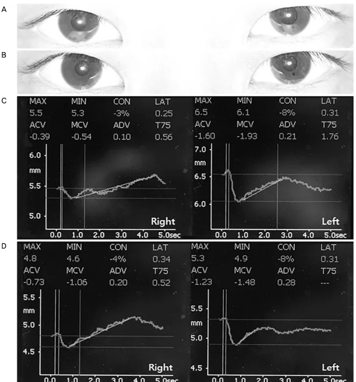 Figure 1. Pupil sizes before and after instillation of 0.0625% pilocarpine. (A) On initial examination, the minimal pupil sizes were  5.3 mm on the right and 6.1 mm on the left