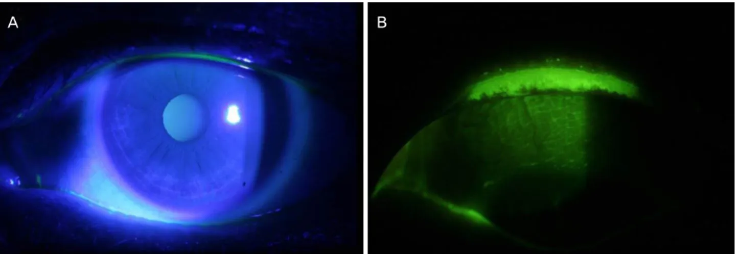 Figure 6. One representative case with lid wiper epitheliopathy. A patient complained of sustained dry eye symptoms, whose Ocular  Surface Disease Index (OSDI) score was 56.2