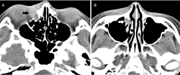 Figure 2. Orbit computed tomography scan. (A) Non-enhance axial computed tomography images show ill-defined hyperdense mass  (black arrow) at right lacrimal sac