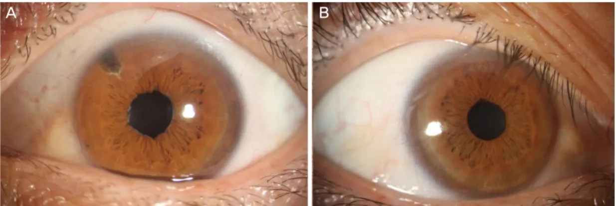 Figure 3. Slit lamp examination at 9 years of follow up. Best corrected visual acuity was 1.0 in both eyes