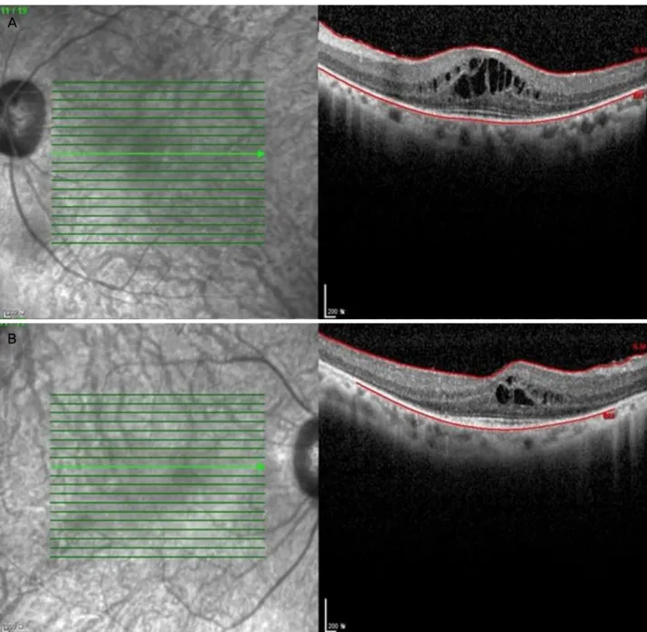 Figure 2. Optical coherence tomography scan showing cystoid macular edema in both eyes