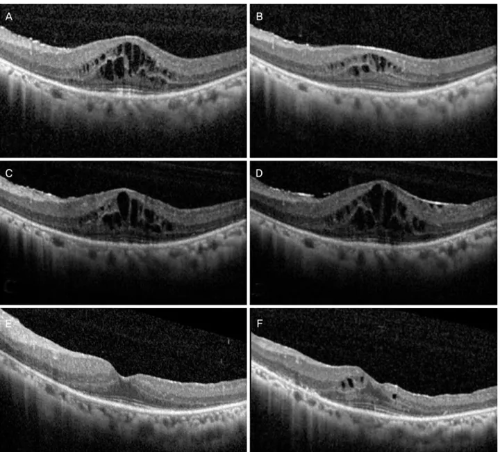 Figure 5. Optical coherence tomography. (A) 1 month after aflibercept injection. (B) 1 month after dexamethasone implant injection