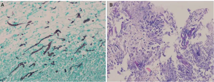 Figure 3. Histopathology of the sphenoid sinus tissue showed hyphae, consistent with the aspergillosis