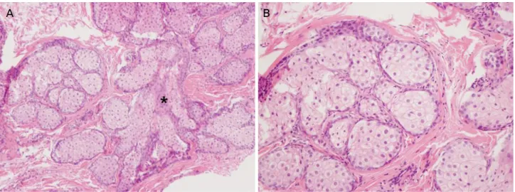 Figure 3. Pathologic findings of the mass in the left lacrimal caruncle. (A) Hyperplastic sebaceous lobules connected to dilated cen- cen-tral sebaceous duct (asterisk) (hematoxylin and eosin [H&amp;E] stain, ×100)