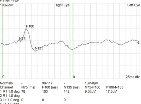 Figure 2. Pattern visual evoked potential (VEP) of Case 1. Pattern VEP showed low amplitude in the affected left eye.