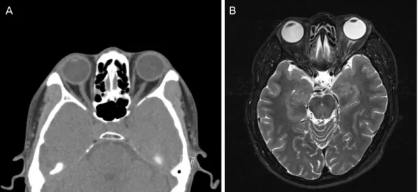 Figure 3. Computed tomography (CT) and magnetic resonance image (MRI) of the case 1 patient