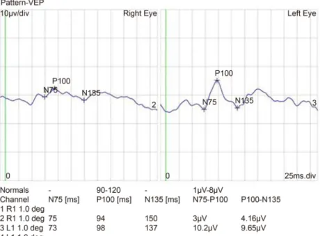 Figure 5. Pattern visual evoked potential (VEP) of Case 2. Pattern VEP showed reduction in the amplitude in the right eye.