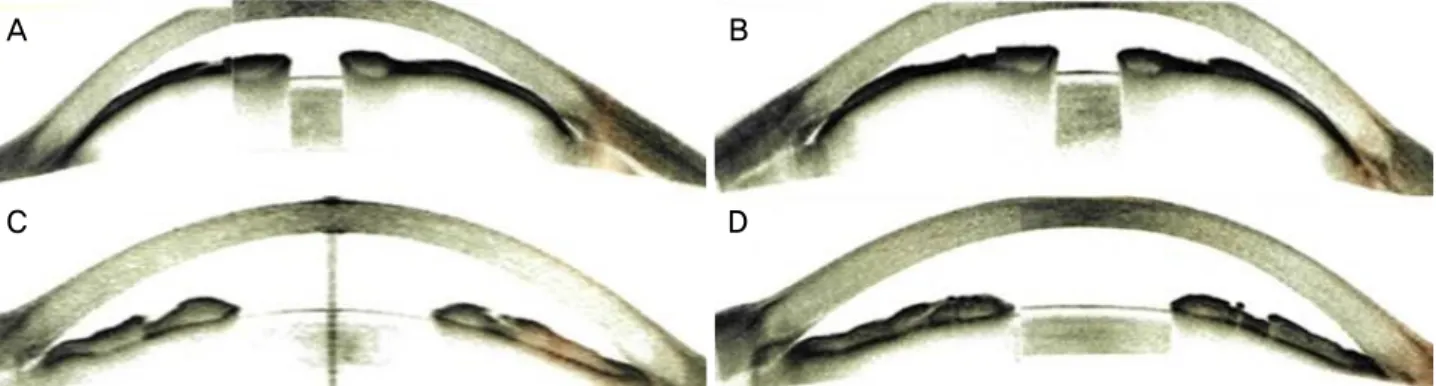 Figure 1. Optical coherence tomography images of anterior segment in both eyes. Optical coherence tomography images of anterior  segment show narrow anterior chamber angle with forward displacement of iris-lens diaphragm in the right eye (A) and the left e