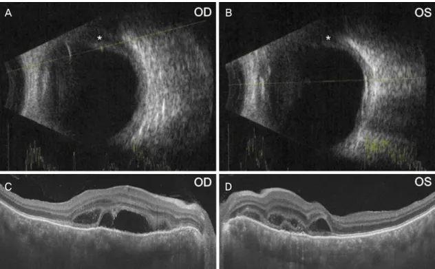 Figure 2. B-scan and optical coherence tomography images in both eyes. B-scan images demonstrate ciliochoroidal effusion (white  asterisk) in the right eye (A) and the left eye (B)