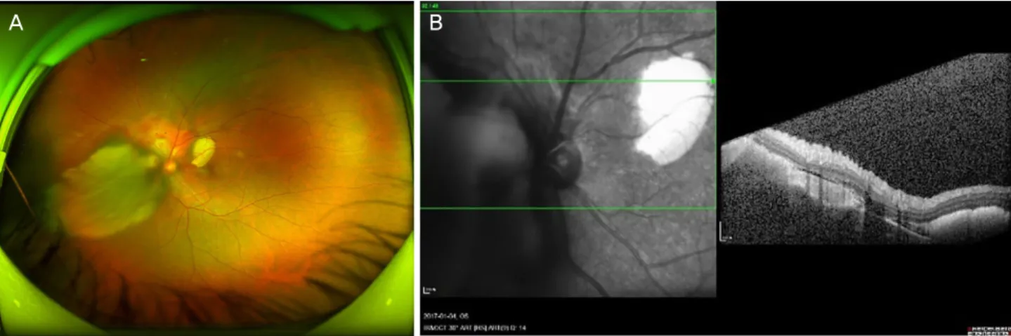 Figure 1. Ultrawide fundus photograph (UW FP) of the left eye. UWFP shows a well demarcated, orange-colored elevated lesion in- in-volving superior peripapillary area with massive subretinal hemorrhage extending to the macular area (A)