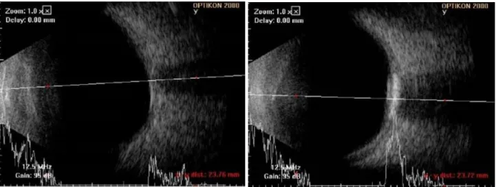 Figure 3. B-scan ultrasonography (USG). B-scan USG demonstrates slightly elevated, highly reflective choroidal mass with posteri- posteri-or acoustic shadowing