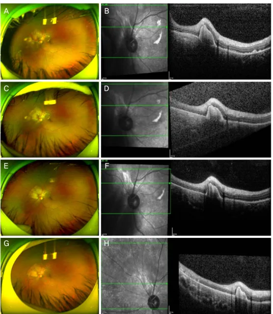 Figure 4. Ultrawide fundus photograph (UWFP) and optical coherence tomography (OCT) of the left eye