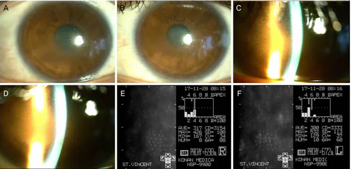 Figure 1. Cornea at first visit of case 1. Edematouscornea by slit lamp microscopic examination (right eye [A], left eye [B])