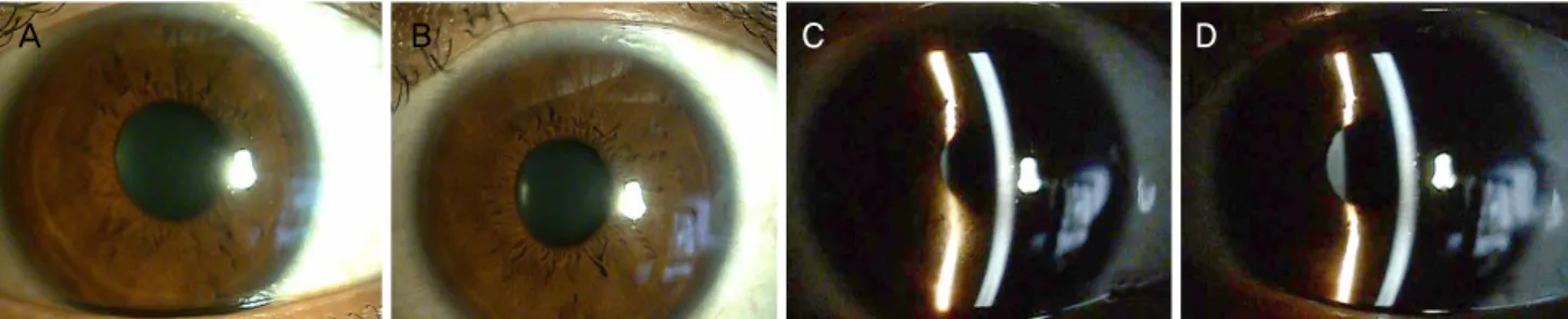 Figure 3. Cornea at third visit of case 1. Slight remained cornea edema by slit lamp microscopic examinationat third visit (right eye  [A], left eye [B])