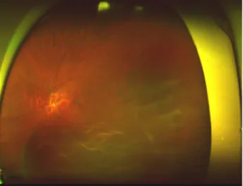 Figure 1. Ultra wide field fundus photograph at the initial  examination. Note the macula-involved retinal detachment.