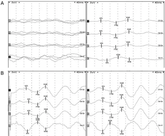 Figure 4. The standard visual evoked potential (VEP) waveform in response to flash stimuli