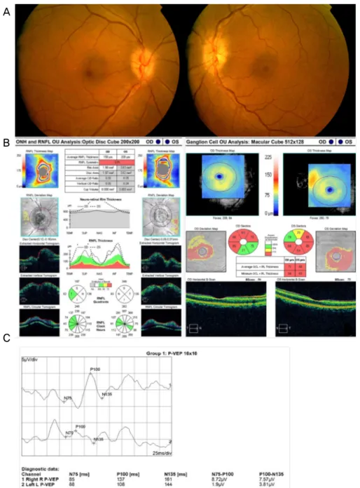 Figure 1. Ocular findings at initial presentation: fundus photographs, optical coherence tomography (OCT), and pattern visual  evoked potential (VEP)