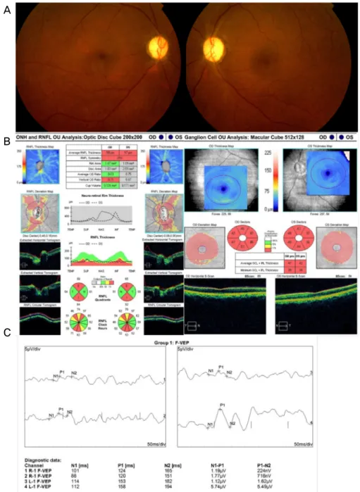 Figure 3. Ocular findings at 3 months after the initial presentation: fundus photographs, optical coherence tomography and flash vis- vis-ual evoked potential (VEP)