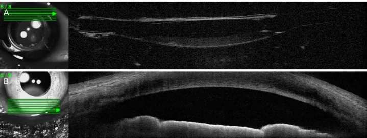 Figure 5. Slit-lamp photograph 8 weeks after admission, anir- anir-idia with a well-centered IOL in an intact capsular bag
