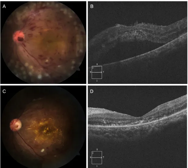 Figure 2. Post-operative fundus photograph and optical coherence tomography (OCT) of case 1