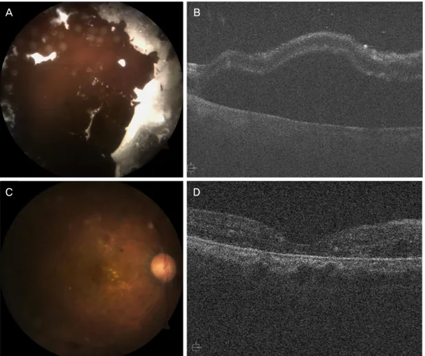 Figure 4. Post-operative fundus photograph and optical coherence tomography (OCT) of case 2