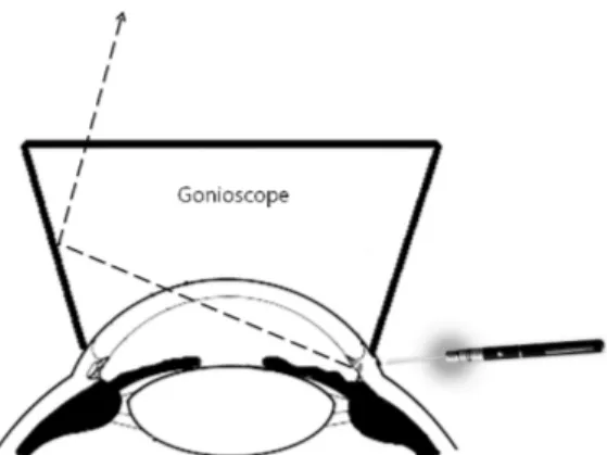 Figure 2. Schematic diagram to illustrate how to localize cy- cy-clodialysis cleft with the laser pointer during gonioscopic  examination