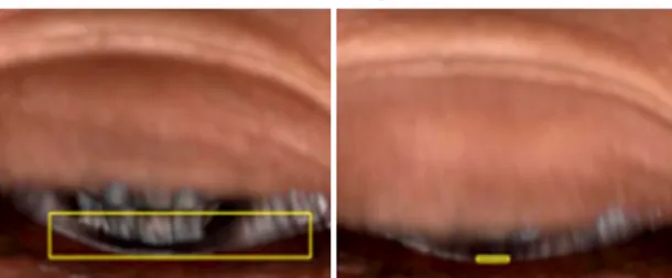 Figure 1. LipiView® (TearScience Inc., Morrisville, NC, USA) Image. Yellow box indicates partial blinking in both eye detecting  light interference reflected from lipid layer in tear meniscus.