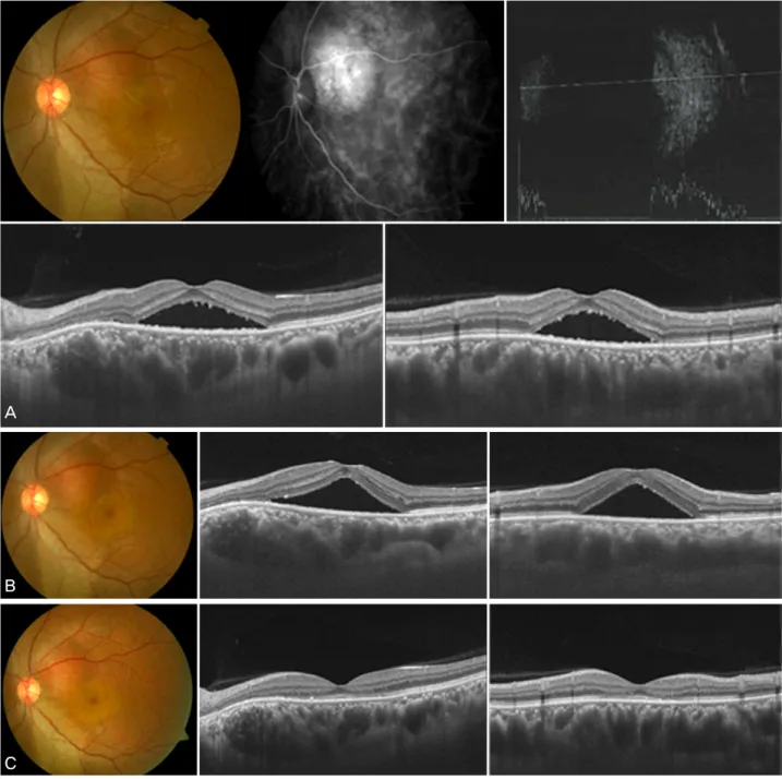Figure 1. Representative case 4 having an exudative retinal detachment in circumscribed choroidal hemangioma (CCH)
