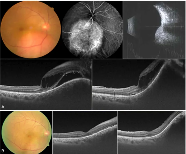 Figure 2. Representative case 9 having an exudative retinal detachment in circumscribed choroidal hemangioma (CCH)